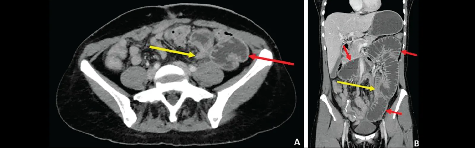 CECT Whole Abdomen Side Effects?